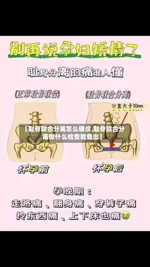 【耻骨联合分离怎么确诊,耻骨联合分离做什么检查能查出】-第2张图片