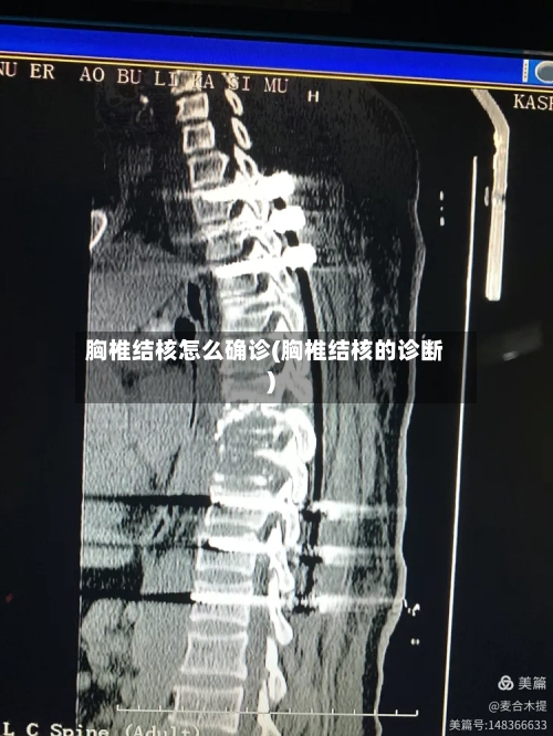 胸椎结核怎么确诊(胸椎结核的诊断)-第2张图片