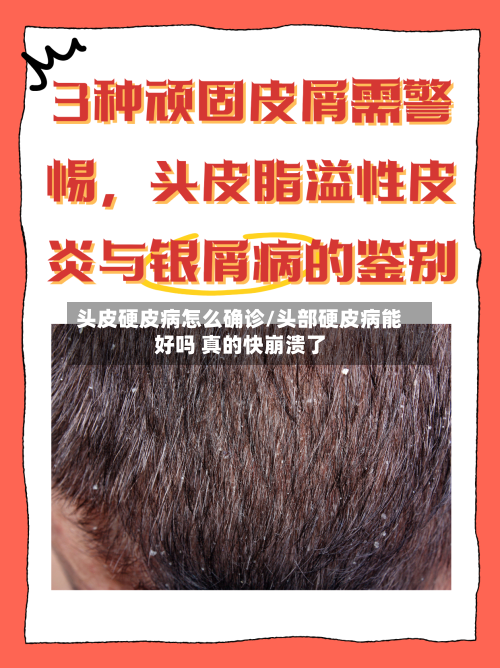 头皮硬皮病怎么确诊/头部硬皮病能好吗 真的快崩溃了-第2张图片