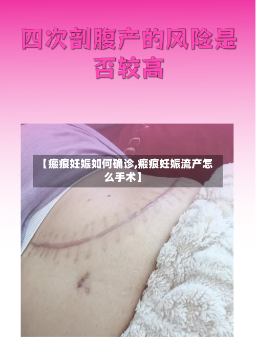 【瘢痕妊娠如何确诊,瘢痕妊娠流产怎么手术】-第2张图片