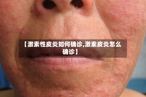 【激素性皮炎如何确诊,激素皮炎怎么确诊】-第1张图片