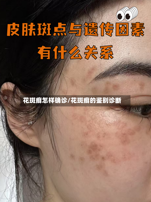 花斑癣怎样确诊/花斑癣的鉴别诊断-第2张图片