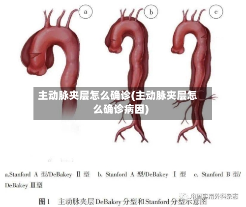 主动脉夹层怎么确诊(主动脉夹层怎么确诊病因)